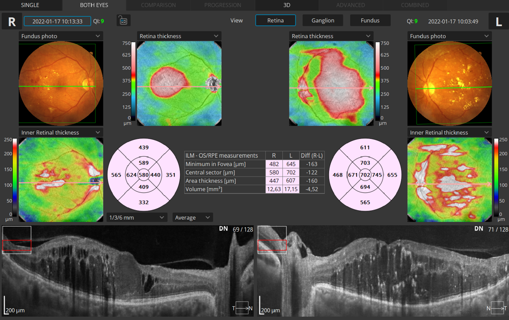 ​Retina 3D Les deux yeux